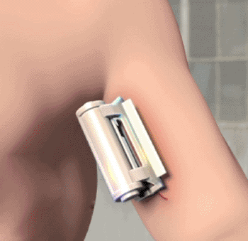 Image: The ITClamp closing a wound (Photo courtesy of ITC).